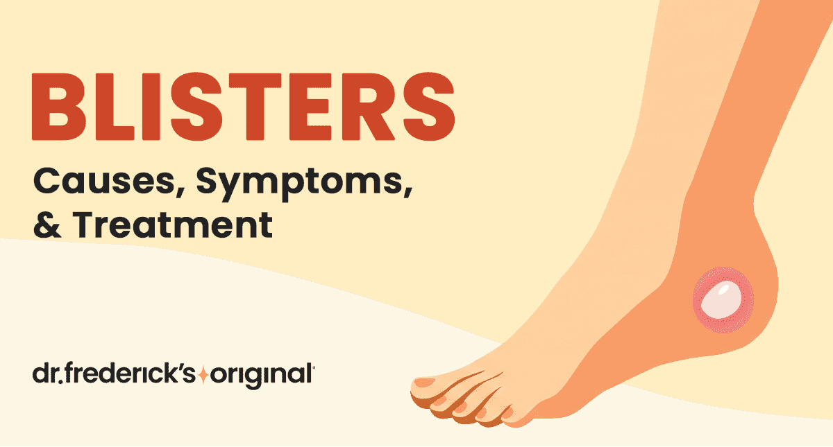 Blisters: Symptoms, Causes, Types and Treatments