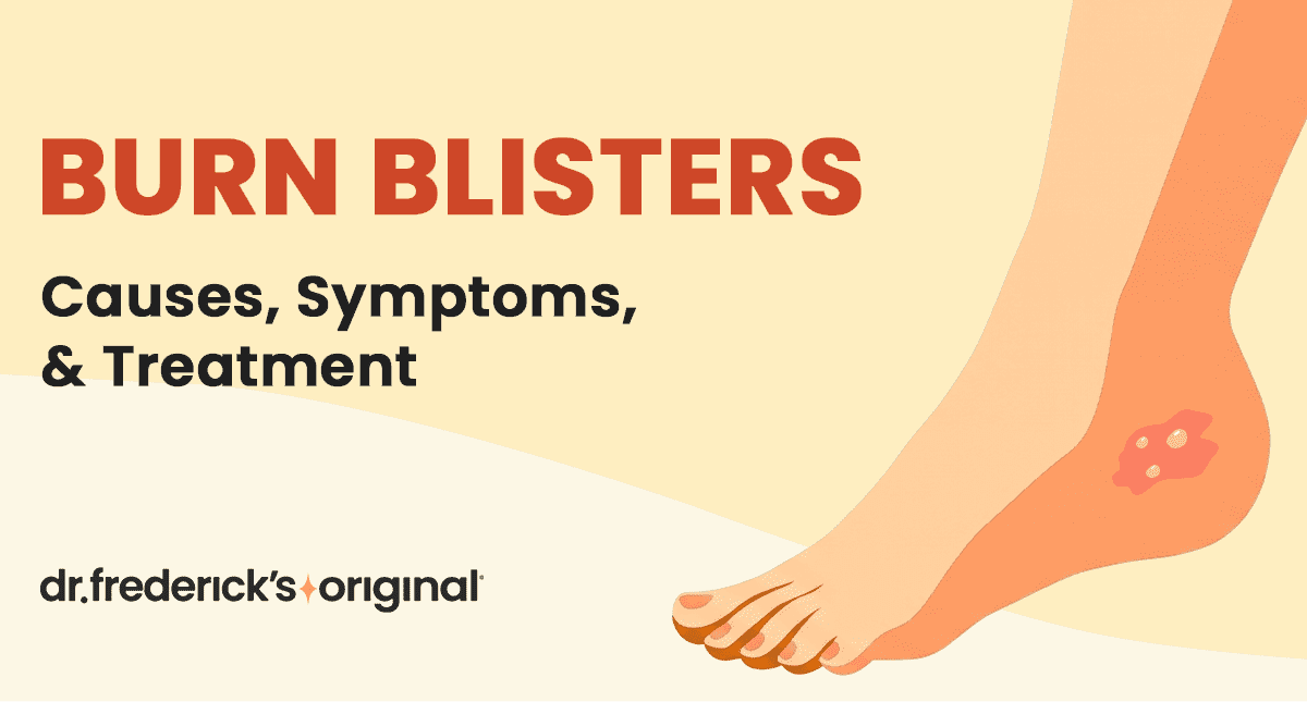 Burn Blister: First Aid and Treatment