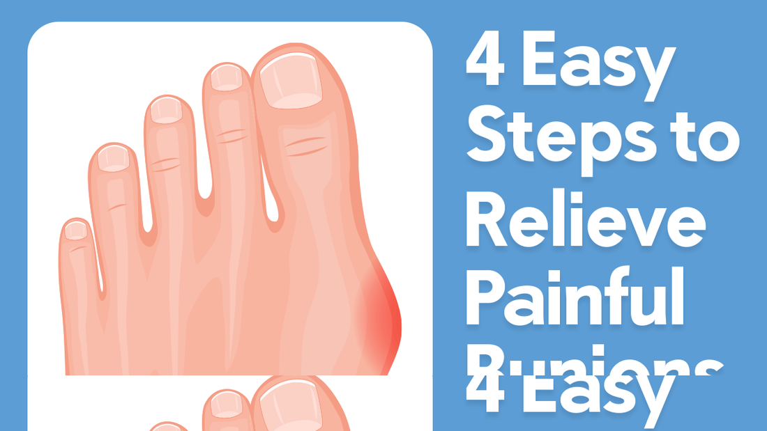 4 Easy Steps to Relieve Painful Bunions