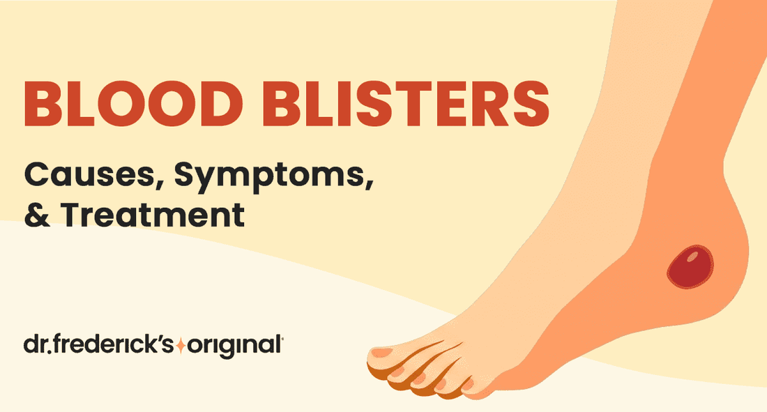 Blood Blister: Causes, Treatment and Symptoms