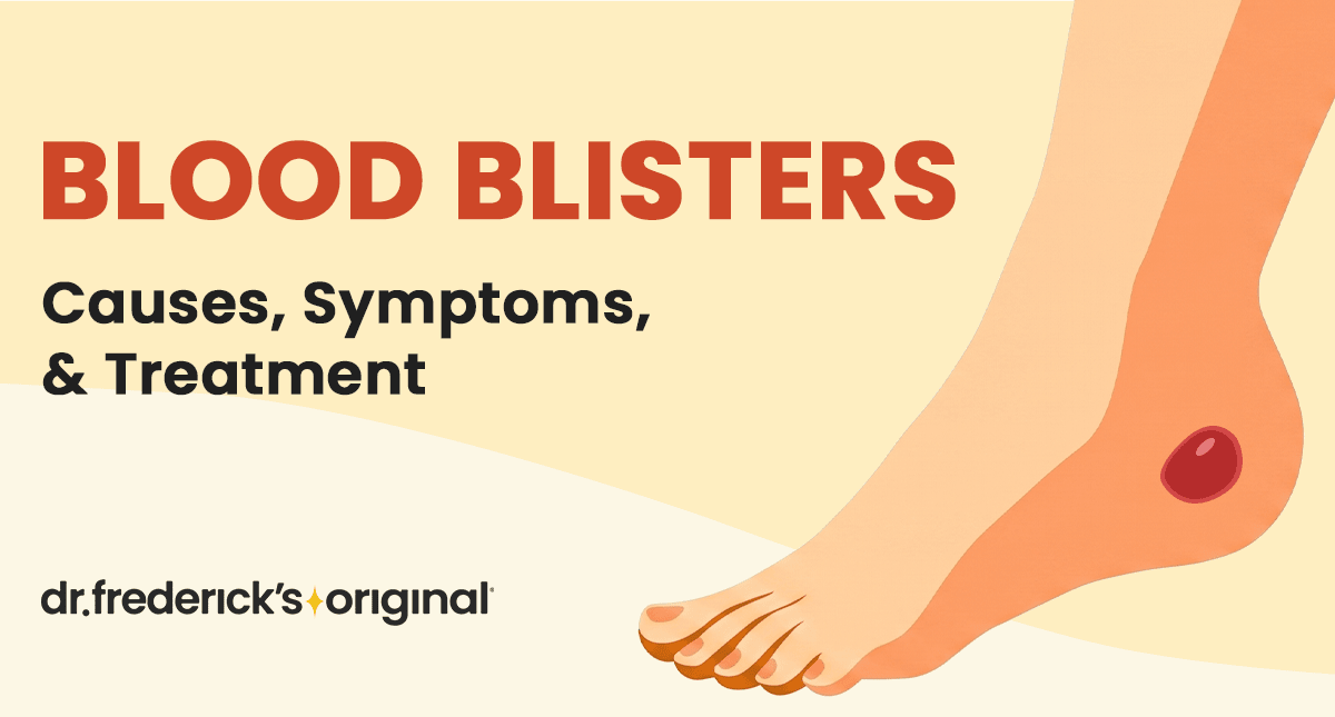 Blood Blister: Causes, Treatment and Symptoms