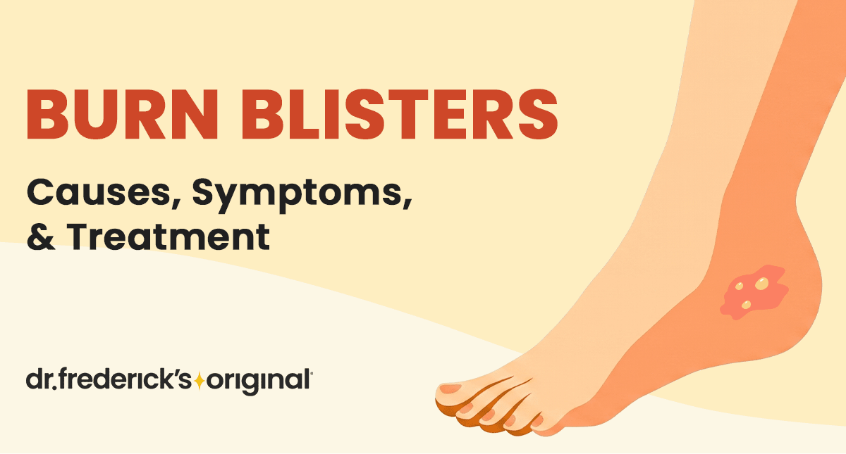 Burn Blister: First Aid and Treatment